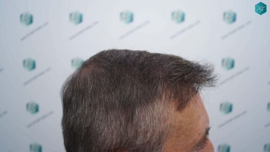 Injerto Capilar Técnica FUE Grafts 4924 (11170 Pelos) 32 36 RESULTADOS A LOS 12 MESES