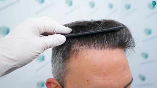 Injerto Capilar Técnica FUE Grafts 3362 (8806 Pelos) 35 37 RESULTADOS A LOS 12 MESES 1