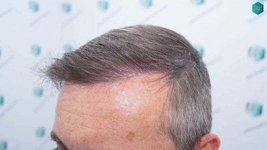 Injerto Capilar Técnica FUE Grafts 4924 (11170 Pelos) 33 37 RESULTADOS A LOS 12 MESES