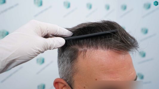 Injerto Capilar Técnica FUE Grafts 3362 (8806 Pelos) 34 38 RESULTADOS A LOS 12 MESES 1