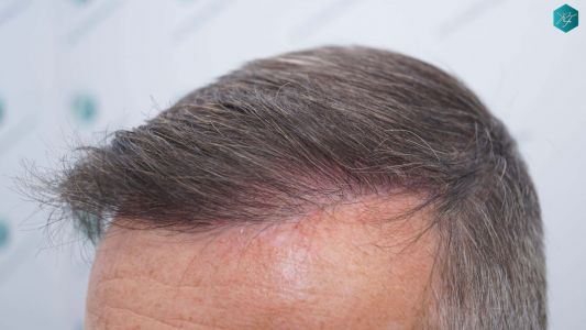 Injerto Capilar Técnica FUE Grafts 4924 (11170 Pelos) 34 38 RESULTADOS A LOS 12 MESES