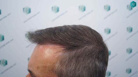 Injerto Capilar Técnica FUE Grafts 4924 (11170 Pelos) 35 39 RESULTADOS A LOS 12 MESES