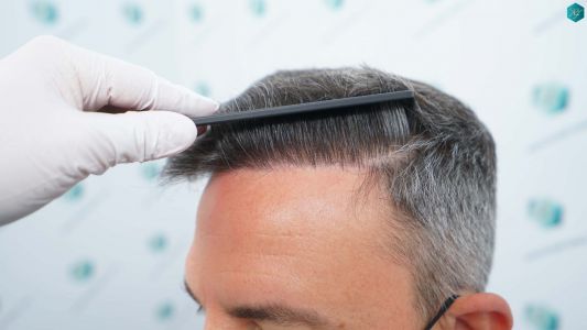Injerto Capilar Técnica FUE Grafts 3362 (8806 Pelos) 37 40 RESULTADOS A LOS 12 MESES 1