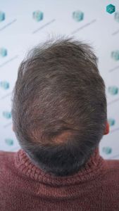 Injerto Capilar Técnica FUE Grafts 4924 (11170 Pelos) 36 40 RESULTADOS A LOS 12 MESES