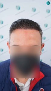 Injerto Capilar Técnica FUE Grafts 3362 (8806 Pelos) 39 41 RESULTADOS A LOS 12 MESES 1