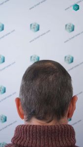 Injerto Capilar Técnica FUE Grafts 4924 (11170 Pelos) 37 41 RESULTADOS A LOS 12 MESES