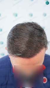 Injerto Capilar Técnica FUE Grafts 3362 (8806 Pelos) 40 41A RESULTADOS A LOS 12 MESES