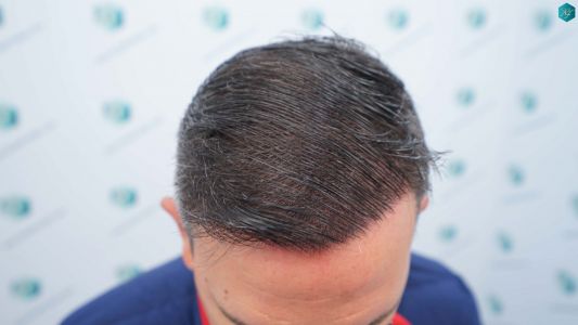 Injerto Capilar Técnica FUE Grafts 3362 (8806 Pelos) 41 41B RESULTADOS A LOS 12 MESES