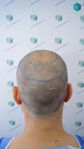 Injerto Capilar Técnica FUE Grafts 4.516 (11.888 Pelos) 34 42 DISENO LINEA INJERTO