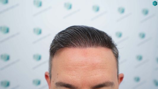 Injerto Capilar Técnica FUE Grafts 3362 (8806 Pelos) 38 42 RESULTADOS A LOS 12 MESES