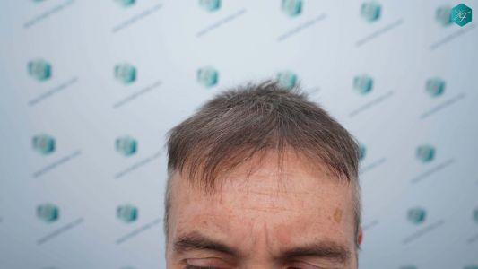 Injerto Capilar Técnica FUE Grafts 4924 (11170 Pelos) 38 43 ANTES DEL TRASPLANTE