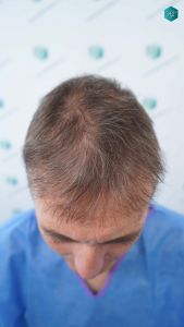Injerto Capilar Técnica FUE Grafts 4924 (11170 Pelos) 39 44 ANTES DEL TRASPLANTE