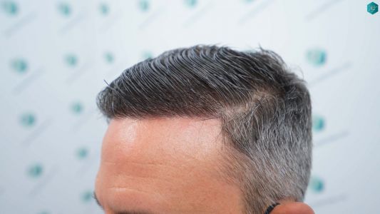 Injerto Capilar Técnica FUE Grafts 3362 (8806 Pelos) 46 44 RESULTADOS A LOS 12 MESES