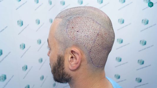 Injerto Capilar Técnica FUE Grafts 4.516 (11.888 Pelos) 36 44 TRASPLANTE CAPILAR