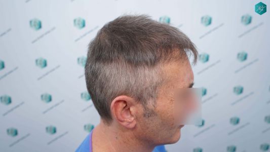 Injerto Capilar Técnica FUE Grafts 4924 (11170 Pelos) 41 45 ANTES DEL TRASPLANTE