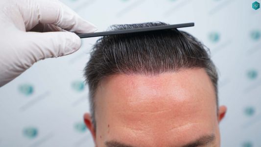 Injerto Capilar Técnica FUE Grafts 3362 (8806 Pelos) 43 45 RESULTADOS A LOS 12 MESES