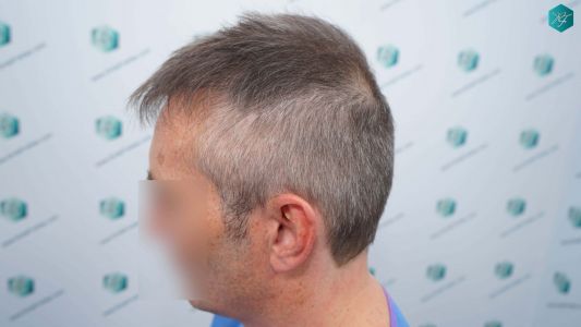 Injerto Capilar Técnica FUE Grafts 4924 (11170 Pelos) 42 46 ANTES DEL TRASPLANTE