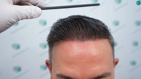 Injerto Capilar Técnica FUE Grafts 3362 (8806 Pelos) 42 46 RESULTADOS A LOS 12 MESES