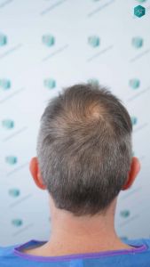 Injerto Capilar Técnica FUE Grafts 4924 (11170 Pelos) 43 47 ANTES DEL TRASPLANTE