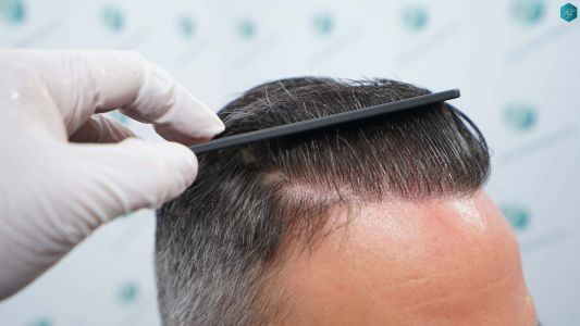 Injerto Capilar Técnica FUE Grafts 3362 (8806 Pelos) 36 47 RESULTADOS A LOS 12 MESES