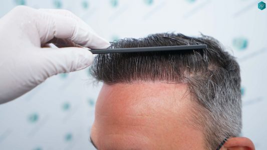 Injerto Capilar Técnica FUE Grafts 3362 (8806 Pelos) 44 48 RESULTADOS A LOS 12 MESES