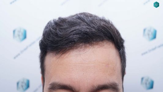 Injerto Capilar Técnica FUE Grafts 4.516 (11.888 Pelos) 39 48 RESULTADOS A LOS 9 MESES