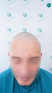 Injerto Capilar Técnica FUE Grafts 4924 (11170 Pelos) 46 49 DISENO LINEA DE INJERTO