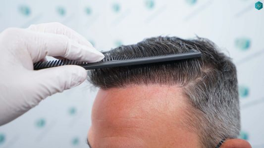 Injerto Capilar Técnica FUE Grafts 3362 (8806 Pelos) 45 49 RESULTADOS A LOS 12 MESES