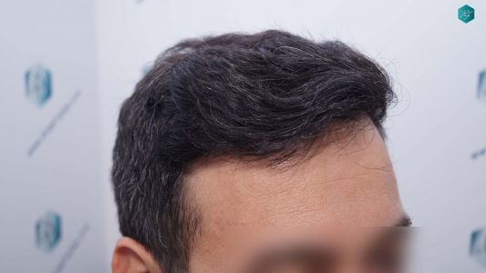 Injerto Capilar Técnica FUE Grafts 4.516 (11.888 Pelos) 40 49 RESULTADOS A LOS 9 MESES