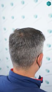 Injerto Capilar Técnica FUE Grafts 3362 (8806 Pelos) 47 49A RESULTADOS A LOS 12 MESES