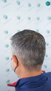 Injerto Capilar Técnica FUE Grafts 3362 (8806 Pelos) 48 49B RESULTADOS A LOS 12 MESES