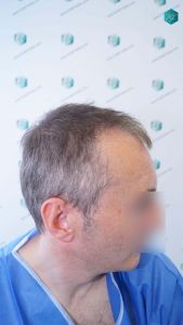 Injerto Capilar Técnica FUE Grafts 4924 (11170 Pelos) 2 4A ANTES DEL TRASPLANTE CAPILAR