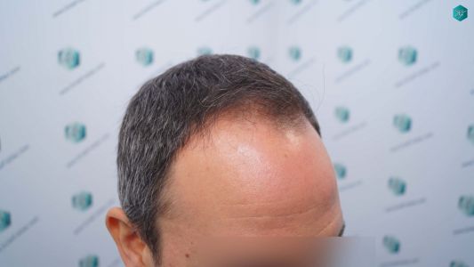 Injerto Capilar Técnica FUE Grafts 3362 (8806 Pelos) 3 5 ANTES DEL TRASPLANTE CAPILAR 2