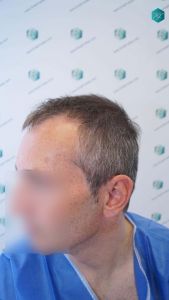 Injerto Capilar Técnica FUE Grafts 4924 (11170 Pelos) 3 5 ANTES DEL TRASPLANTE CAPILAR