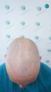Injerto Capilar Técnica FUE Grafts 4924 (11170 Pelos) 47 50 DISENO LINEA DE INJERTO