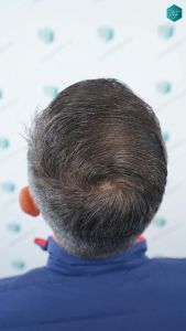 Injerto Capilar Técnica FUE Grafts 3362 (8806 Pelos) 50 50 RESULTADOS A LOS 12 MESES