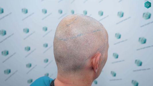 Injerto Capilar Técnica FUE Grafts 4924 (11170 Pelos) 48 51 DISENO LINEA DE INJERTO