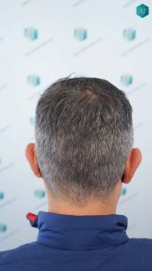 Injerto Capilar Técnica FUE Grafts 3362 (8806 Pelos) 49 51 RESULTADOS A LOS 12 MESES