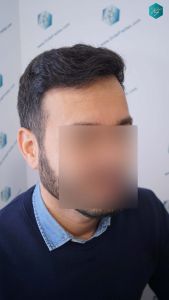 Injerto Capilar Técnica FUE Grafts 4.516 (11.888 Pelos) 41 51 RESULTADOS A LOS 9 MESES