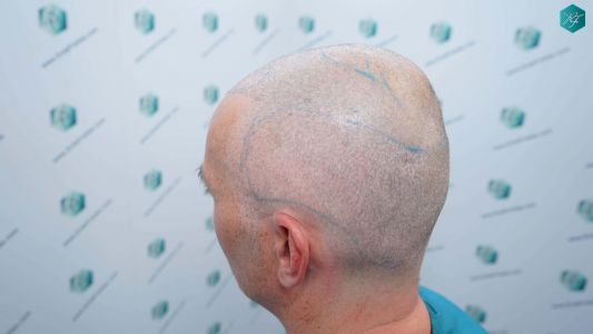 Injerto Capilar Técnica FUE Grafts 4924 (11170 Pelos) 49 52 DISENO LINEA DE INJERTO