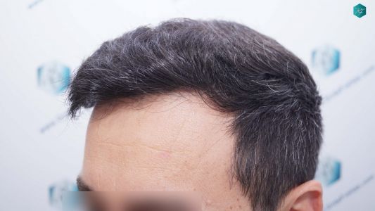 Injerto Capilar Técnica FUE Grafts 4.516 (11.888 Pelos) 42 52 RESULTADOS A LOS 9 MESES