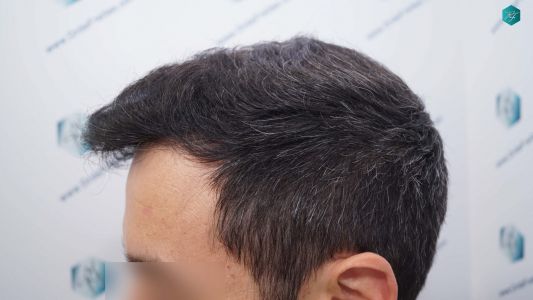 Injerto Capilar Técnica FUE Grafts 4.516 (11.888 Pelos) 43 53 RESULTADOS A LOS 9 MESES