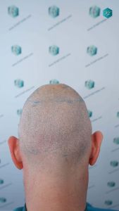 Injerto Capilar Técnica FUE Grafts 4924 (11170 Pelos) 51 54 DISENO LINEA DE INJERTO