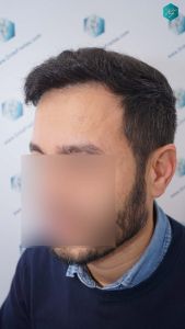 Injerto Capilar Técnica FUE Grafts 4.516 (11.888 Pelos) 44 54 RESULTADOS A LOS 9 MESES