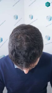 Injerto Capilar Técnica FUE Grafts 4.516 (11.888 Pelos) 46 56 RESULTADOS A LOS 9 MESES