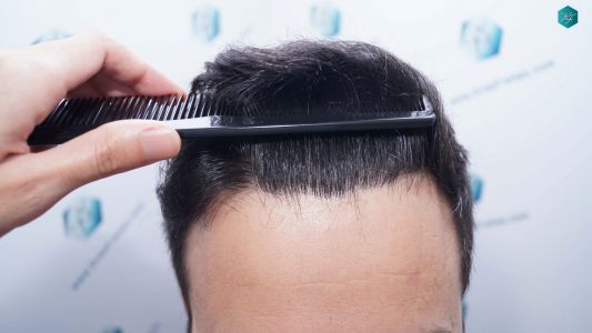 Injerto Capilar Técnica FUE Grafts 4.516 (11.888 Pelos) 47 57 RESULTADOS A LOS 9 MESES