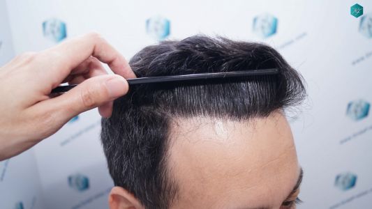 Injerto Capilar Técnica FUE Grafts 4.516 (11.888 Pelos) 48 58 RESULTADOS A LOS 9 MESES