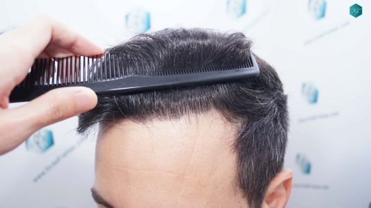 Injerto Capilar Técnica FUE Grafts 4.516 (11.888 Pelos) 49 59 RESULTADOS A LOS 9 MESES