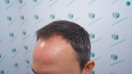 Injerto Capilar Técnica FUE Grafts 3362 (8806 Pelos) 4 6 ANTES DEL TRASPLANTE CAPILAR 2