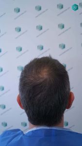 Injerto Capilar Técnica FUE Grafts 4924 (11170 Pelos) 4 6 ANTES DEL TRASPLANTE CAPILAR